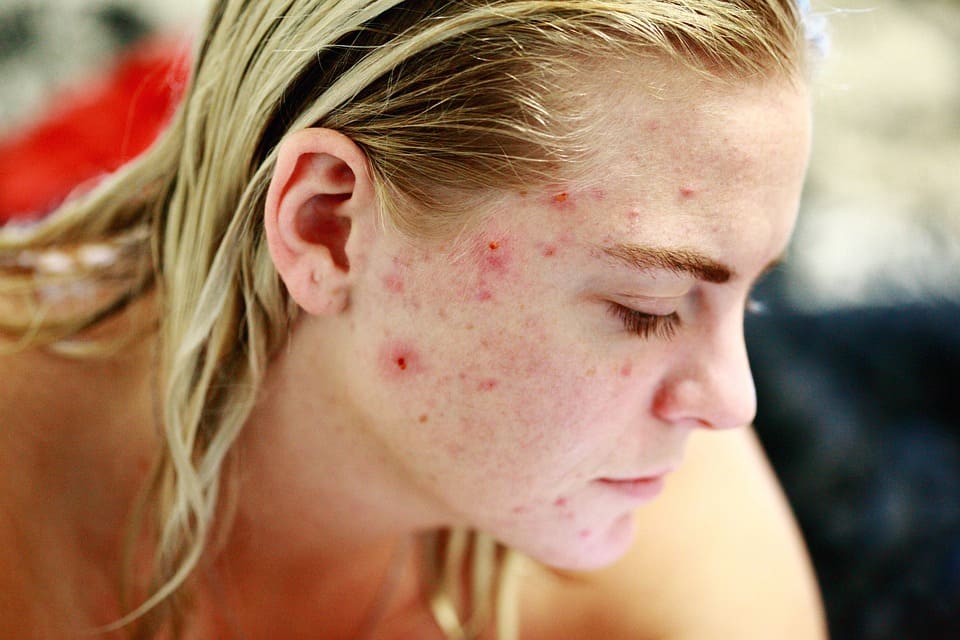 Comment traiter l'acné rosacée? – Quintessence Jade